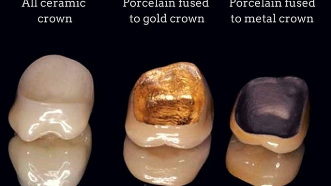 Crowns Costs Teeth For