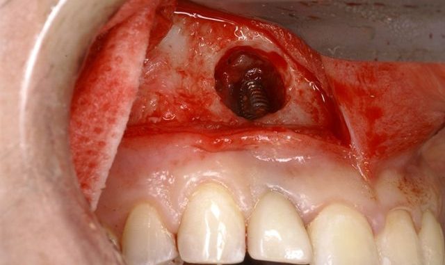 Graft Symptoms Dental Failure Bone.