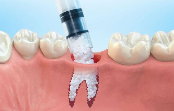 dental-bone-grafting-materials