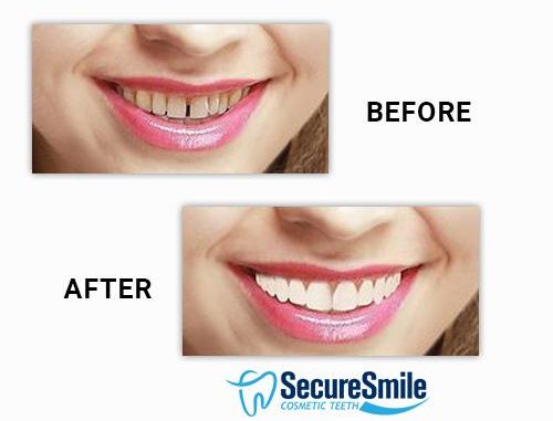 dental-covers-for-teeth