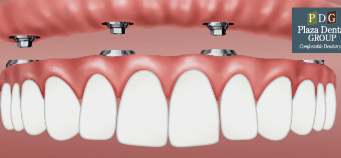 dental-implant-cost-per-tooth