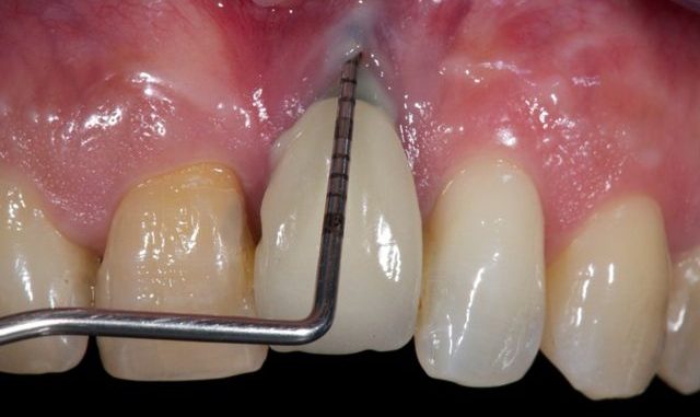 dental-implant-failure