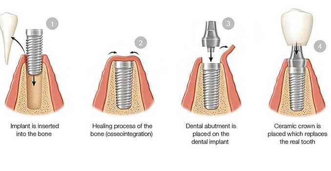 dental-implant-process