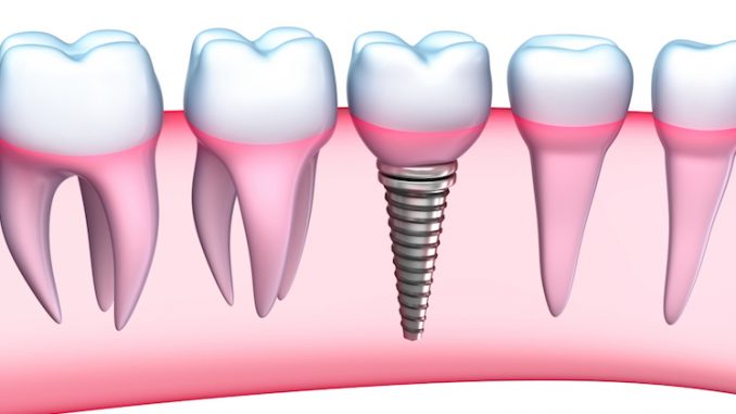 dental-implant-recovery-diet