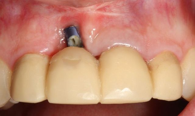 dental-implant-rejection