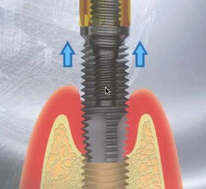 dental-implant-removal