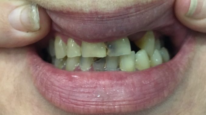 dental-implant-volunteers-needed