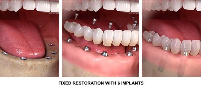 dental-implants-cost-full-mouth-restoration