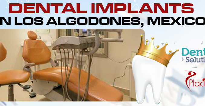 dental-implants-in-los-algodones-mexico
