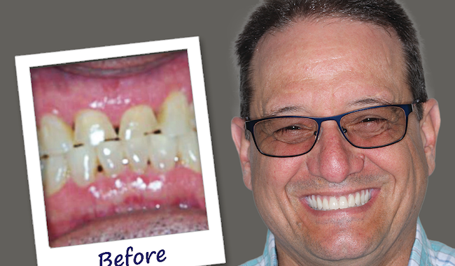 dental-implants-indianapolis