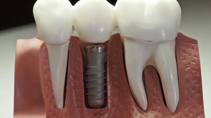 dental-implants-mn