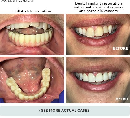 dental-implants-pictures