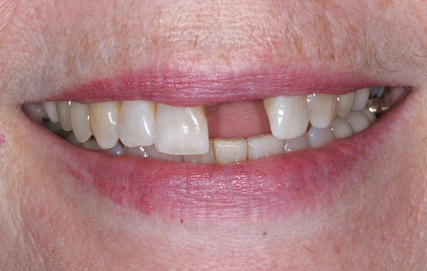 dental-implants-pittsburgh