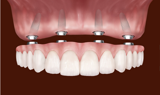 dental-implants-san-antonio