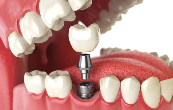 dental-implants-surgery