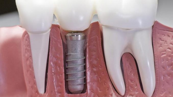 dental-implants-tijuana