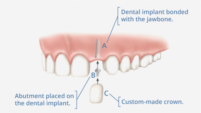 meaning-dental