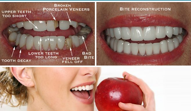 dental-restoration-cost