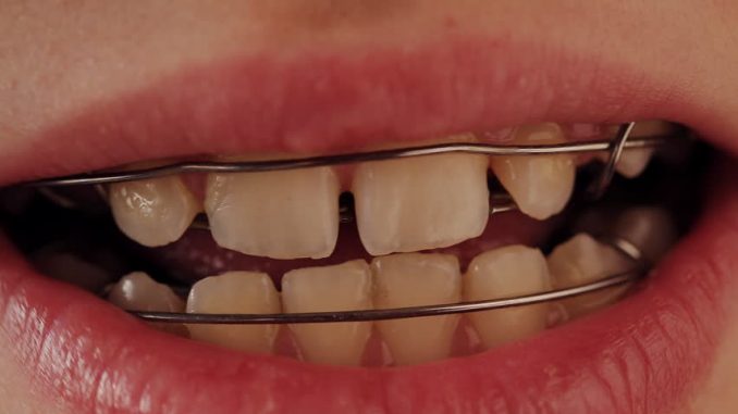 dentist-plates