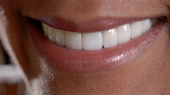 different-types-of-veneers