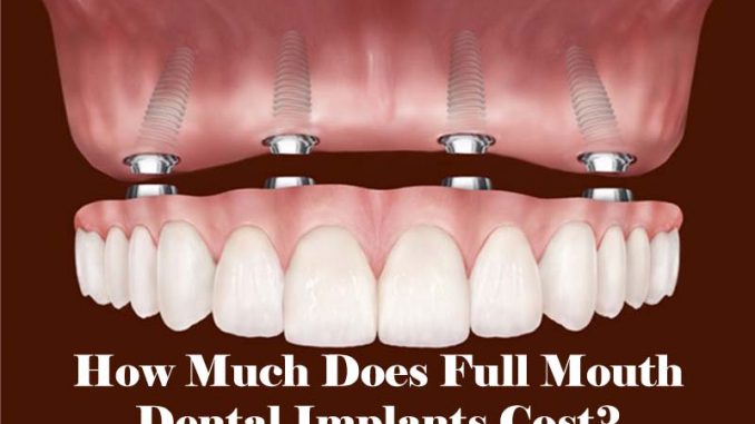 do-insurance-cover-dental-implants
