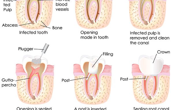 endodontist-meaning