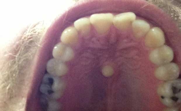 extra-teeth-on-roof-of-mouth