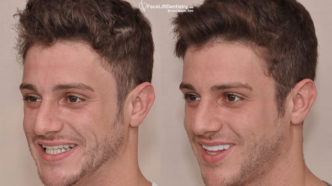 face-lift-dentistry-cost