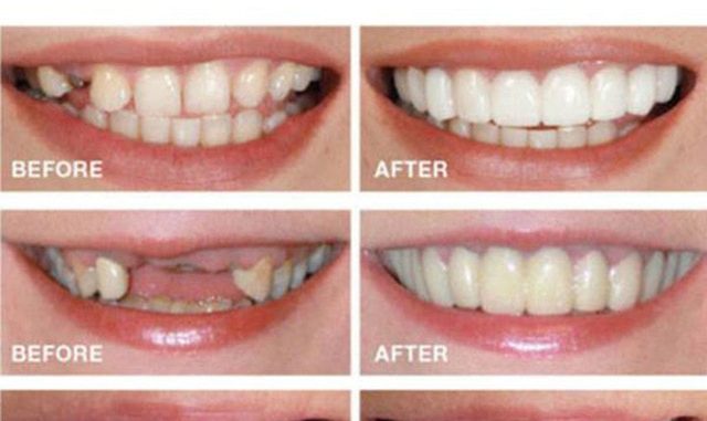 fake-snap-on-teeth