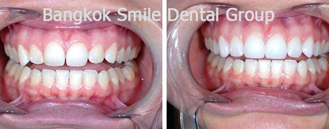 filing-teeth-straight