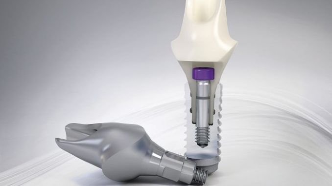 free-dental-implants-grants