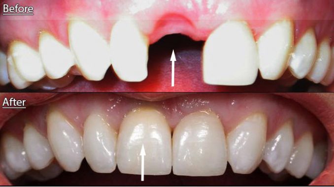 front-tooth-implant