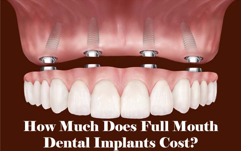 Full Dental Implants Cost 