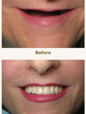 full-mouth-dental-implants-before-and-after