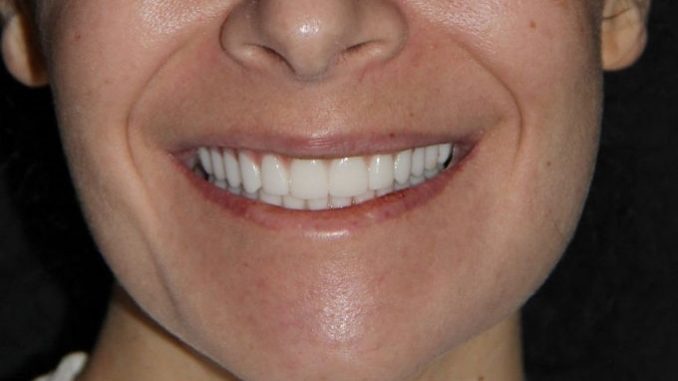 g4-dental-implants