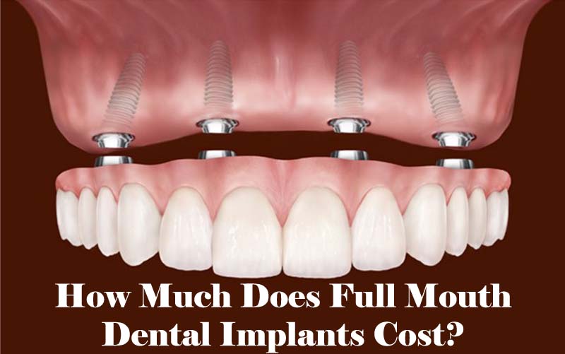 average cost of dental implants