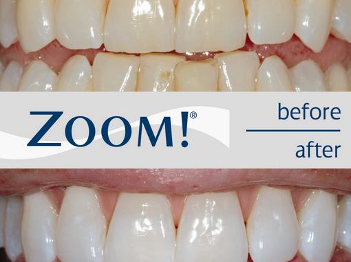 how-much-does-it-cost-to-get-your-teeth-bleached