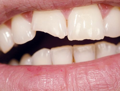 how-to-fix-tooth