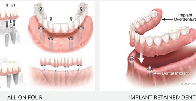 implant-retained-denture