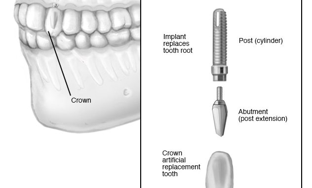 implant-surgeons