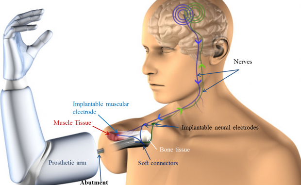 implanted