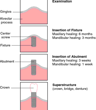 implanted-definition