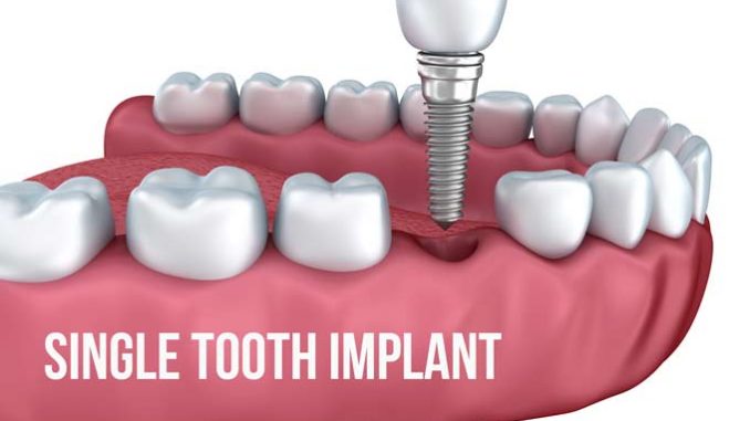 implanted-teeth-price