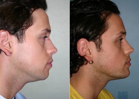 jaw-implants-cost