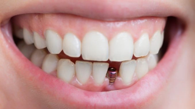 mini-dental-implants-pictures