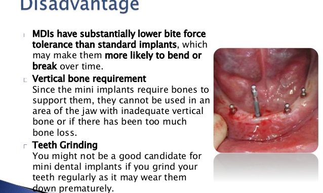 mini-dental-implants-pros-and-cons