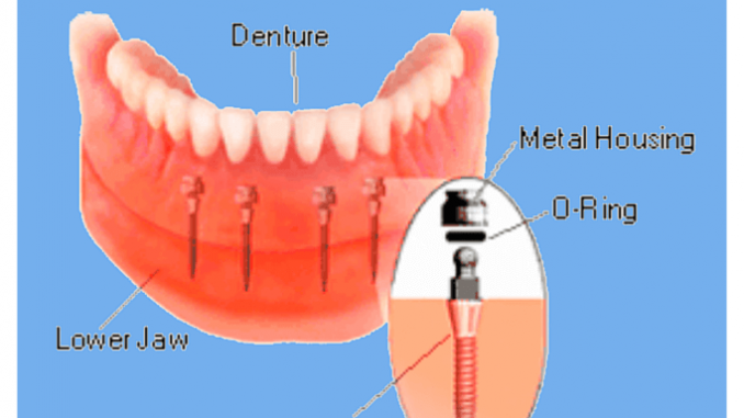mini-dental-implants-reviews