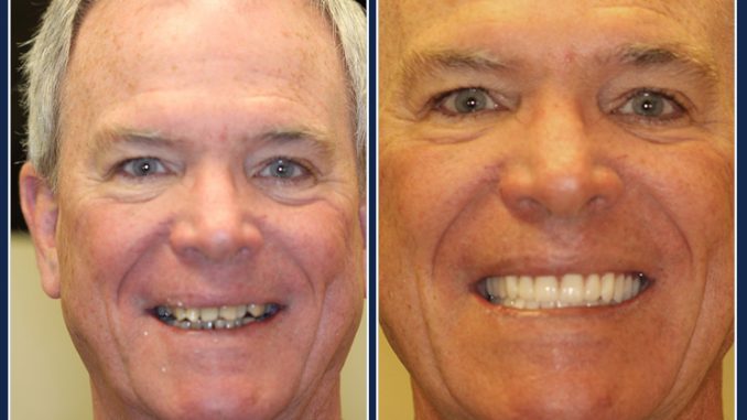 new-teeth-now-cost