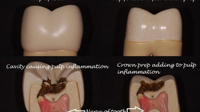 pain-after-crown-placement
