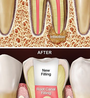 periodontist-root-canal